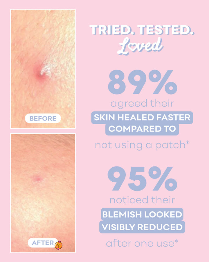 Pimple Fix Overnight Healing Patches