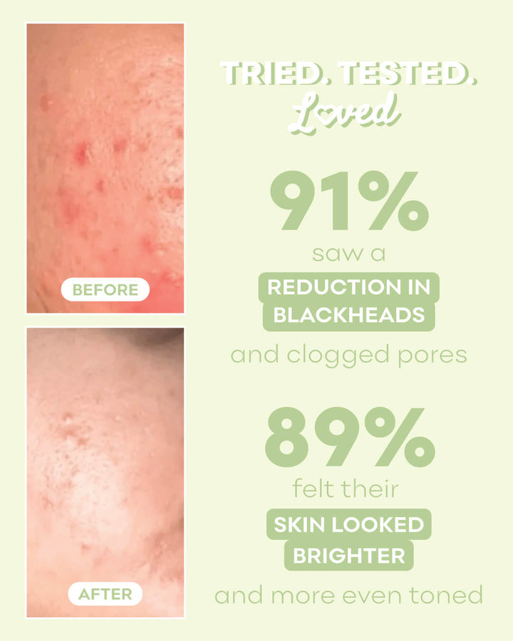 AHA BHA Exfoliating Treatment