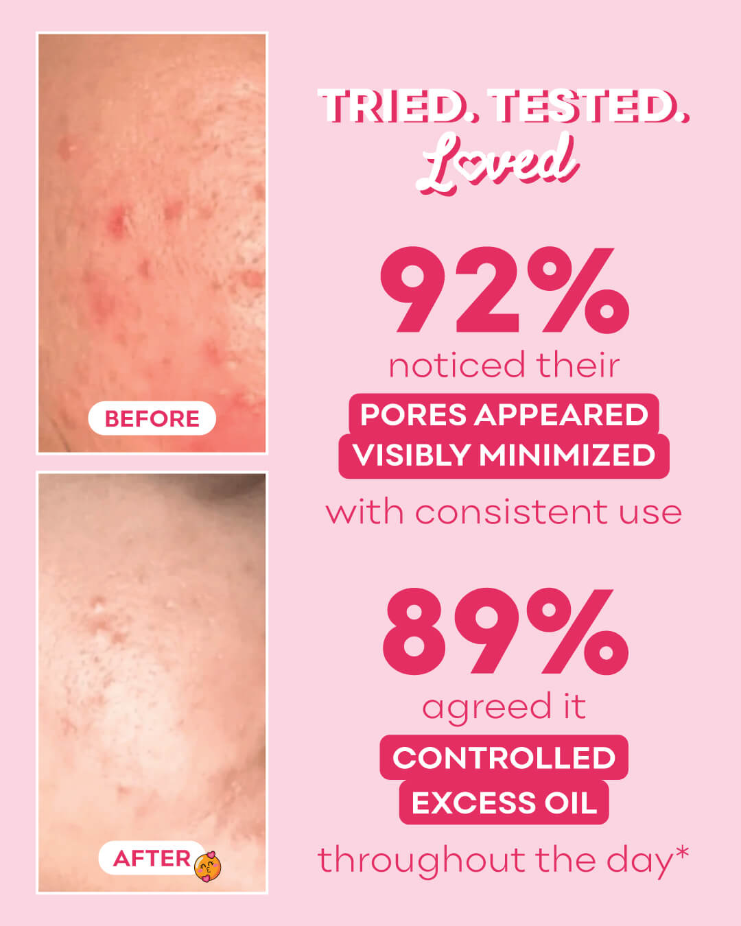 Pink Glow Facial Toner for Oily & Acne Prone Skin