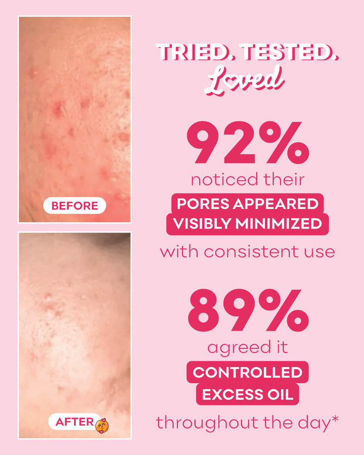Pink Glow Facial Toner for Oily & Acne Prone Skin