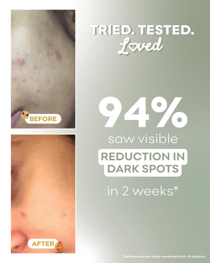 A promotional before-and-after graphic for a skincare product. On the left, two vertical panels show close-up skin results with the words BEFORE and AFTER and a small smiley face icon.